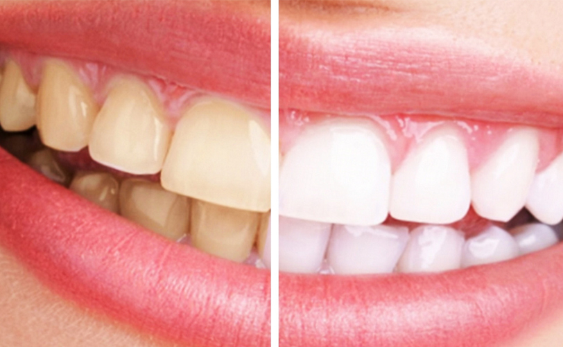 BLANQUEAMIENTO DENTAL