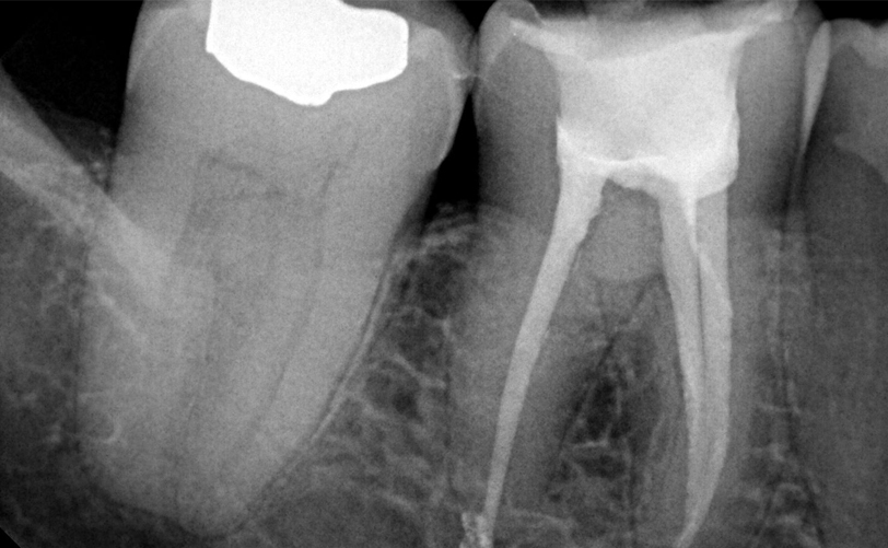ENDODONCIA
