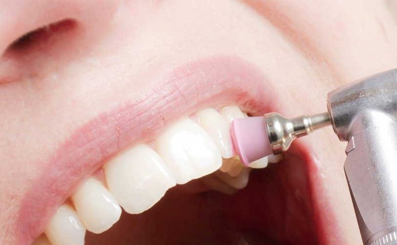 PROFILAXIS DENTAL